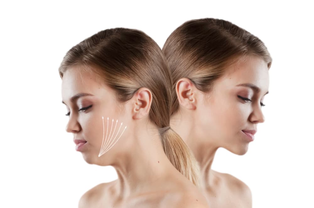 Double Chin - Causes, Treatment, and Removal