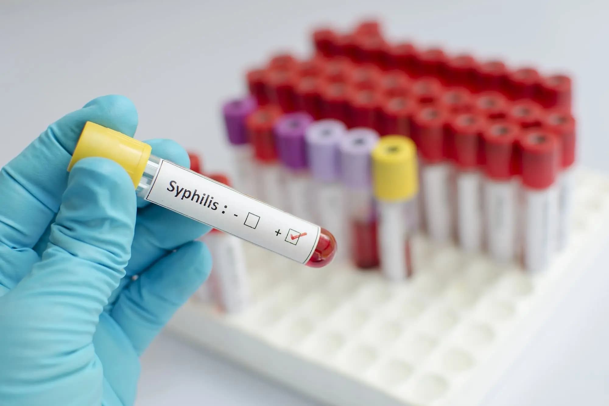 Syphilis: Causes, Symptoms & Treatment