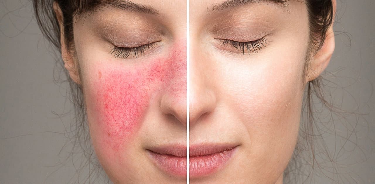 Rosacea Treatment: Causes, Symptoms, Diagnosis, and Care