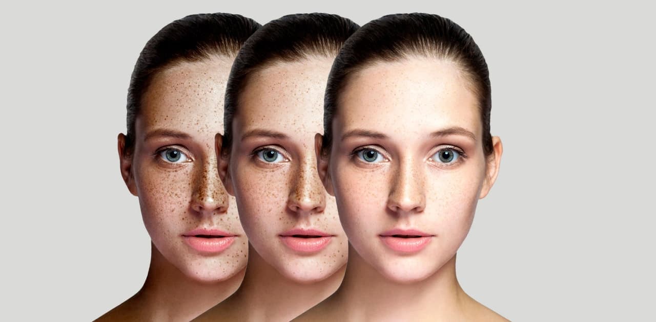 Freckles: What are they? Treatment, Causes & Removal.