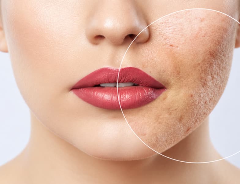 Acne Scars Removal