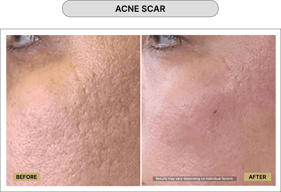 Acne Scar