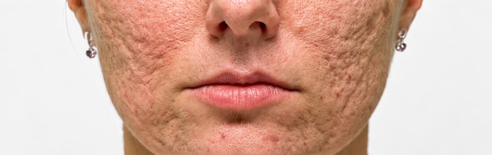 Acne Scars Removal
