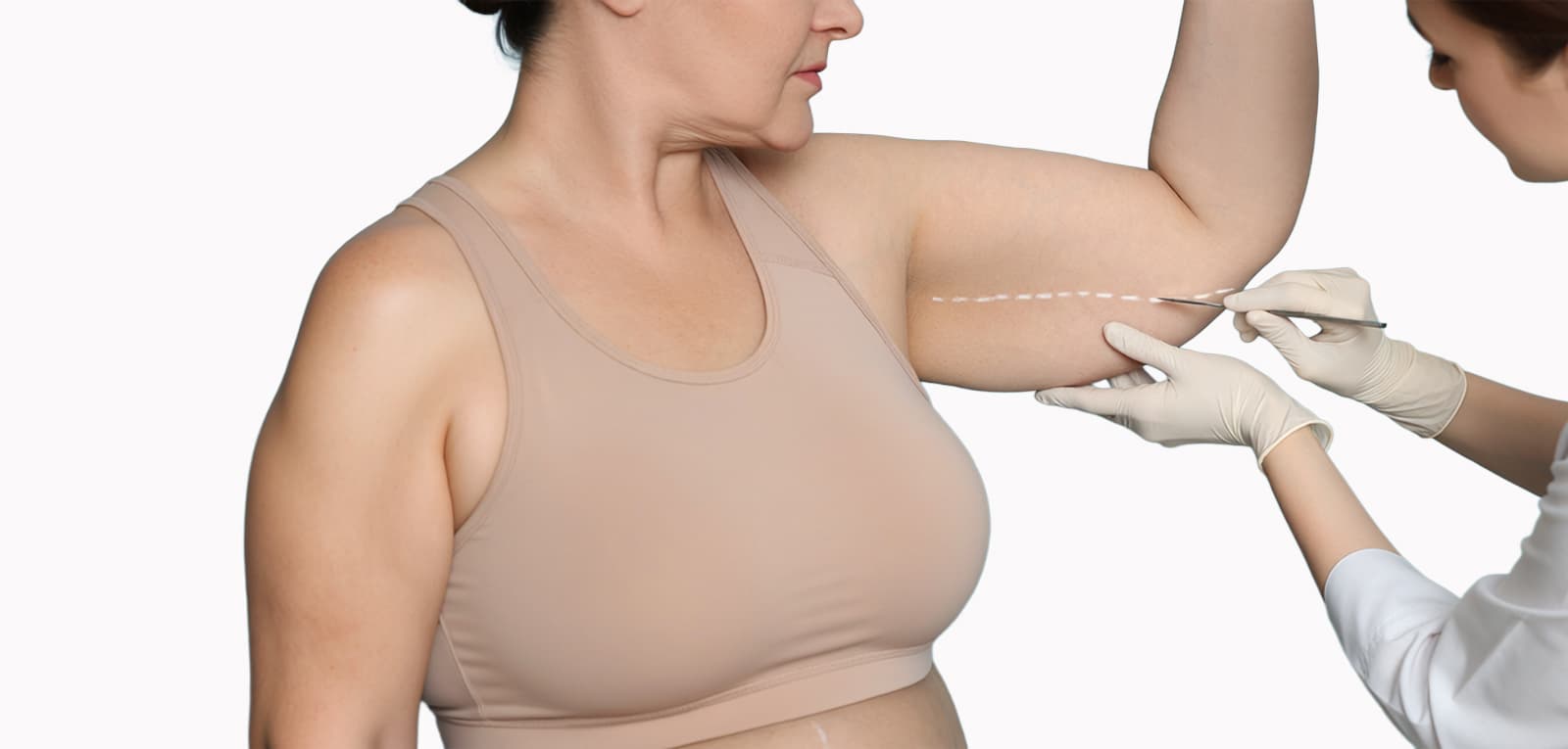 Arm Lift (Brachioplasty) in Dubai