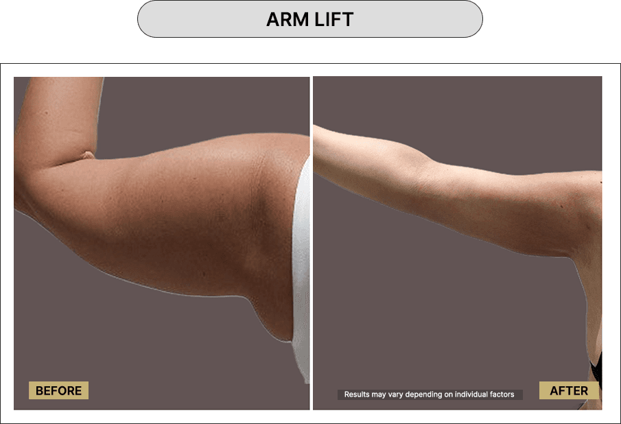 Arm Lift