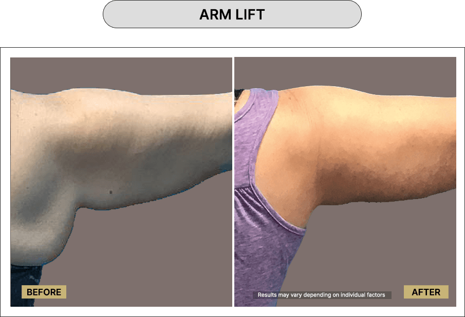 Arm Lift