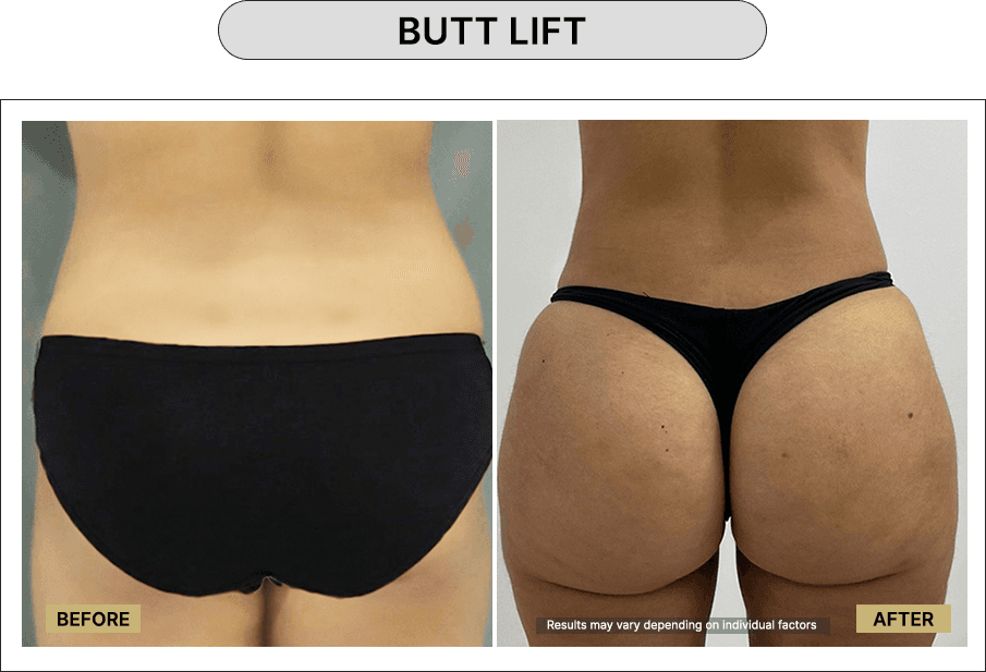 Butt Lift