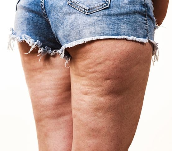 Cellulite cause
