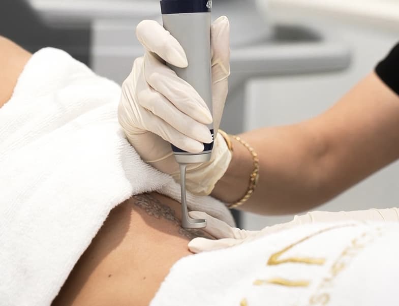 Laser tattoo removal