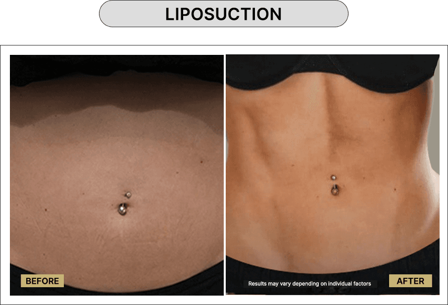 Liposuction
