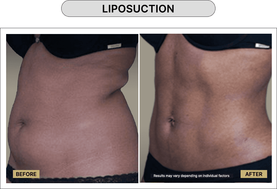 Liposuction