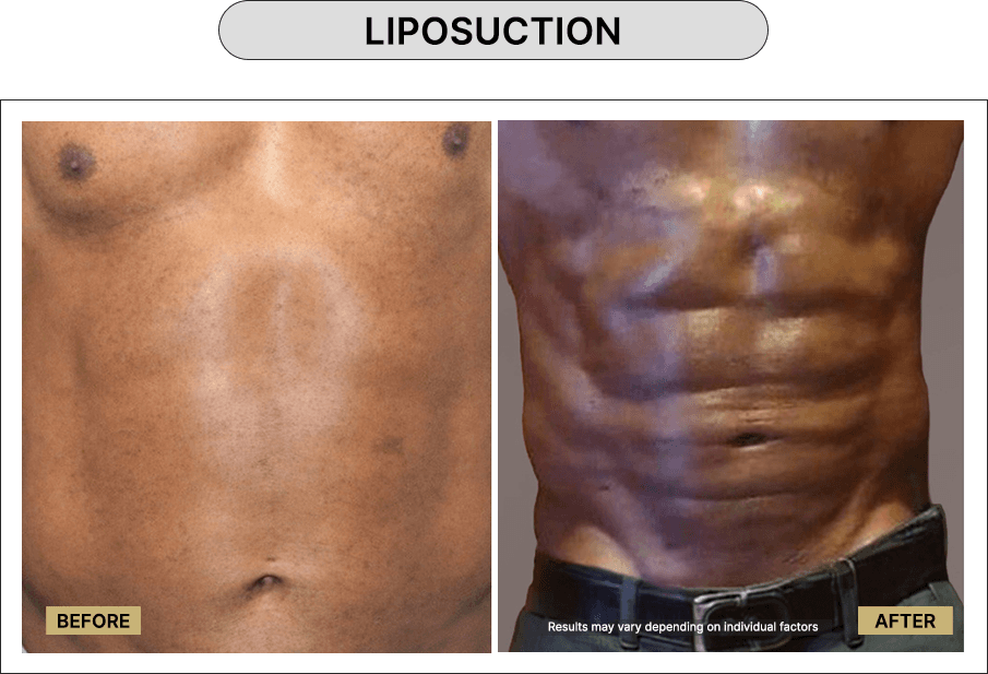 Liposuction