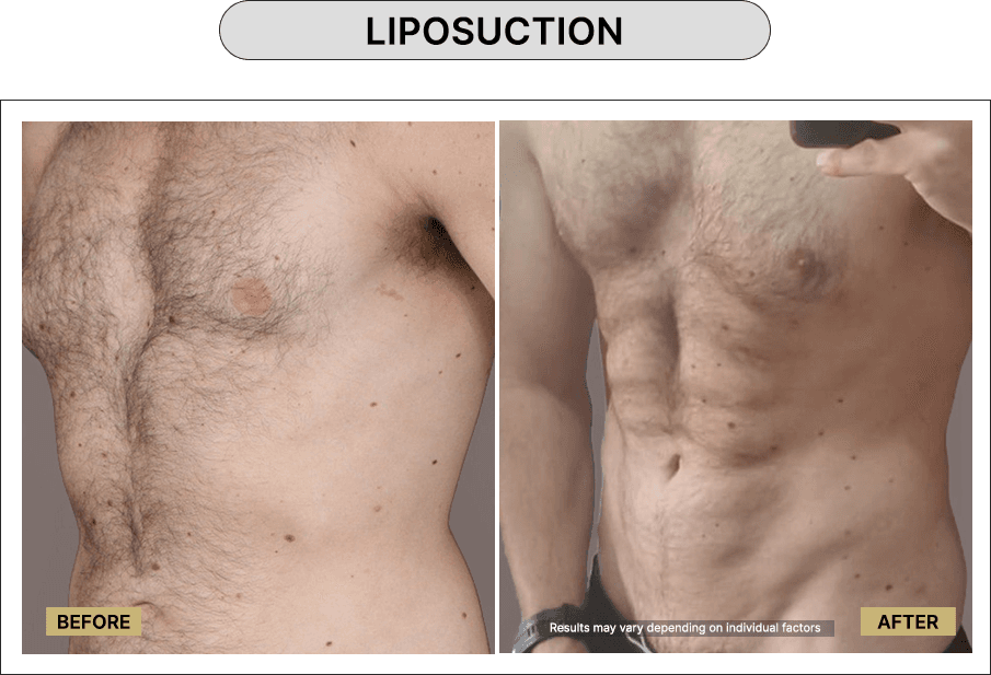 Liposuction