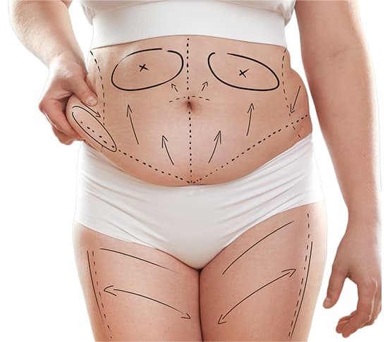 Liposuction