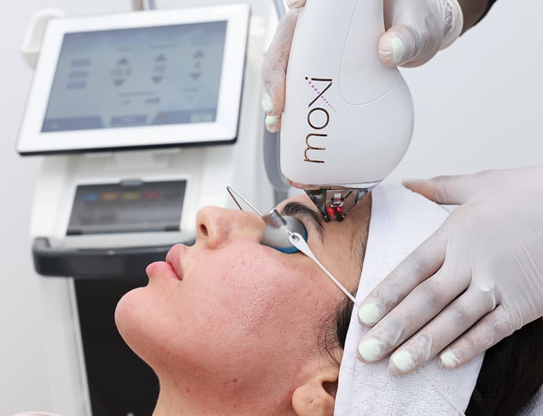 Laser hair removal
