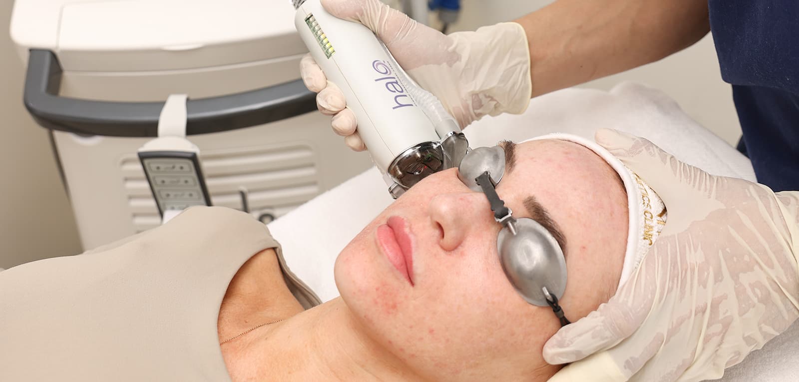 Melasma Treatment in Dubai & Abu Dhabi