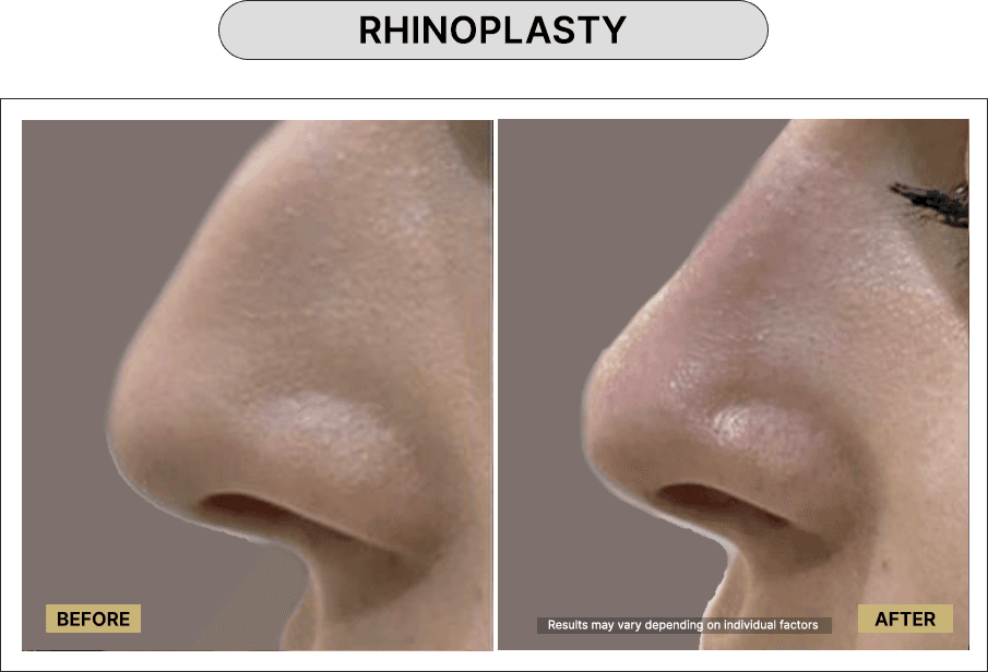 Rhinoplasty
