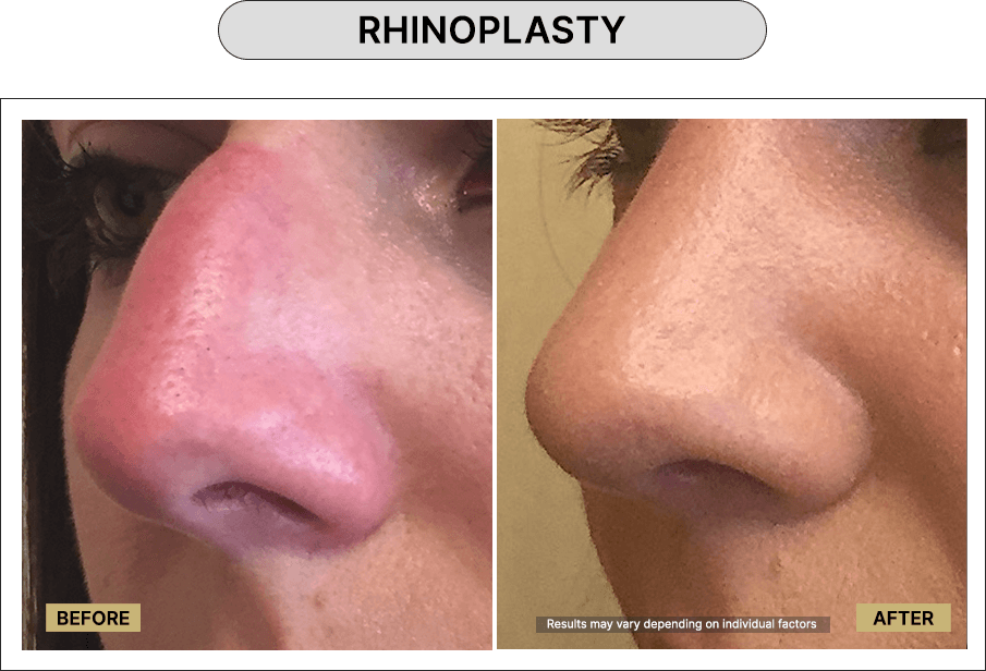 Rhinoplasty