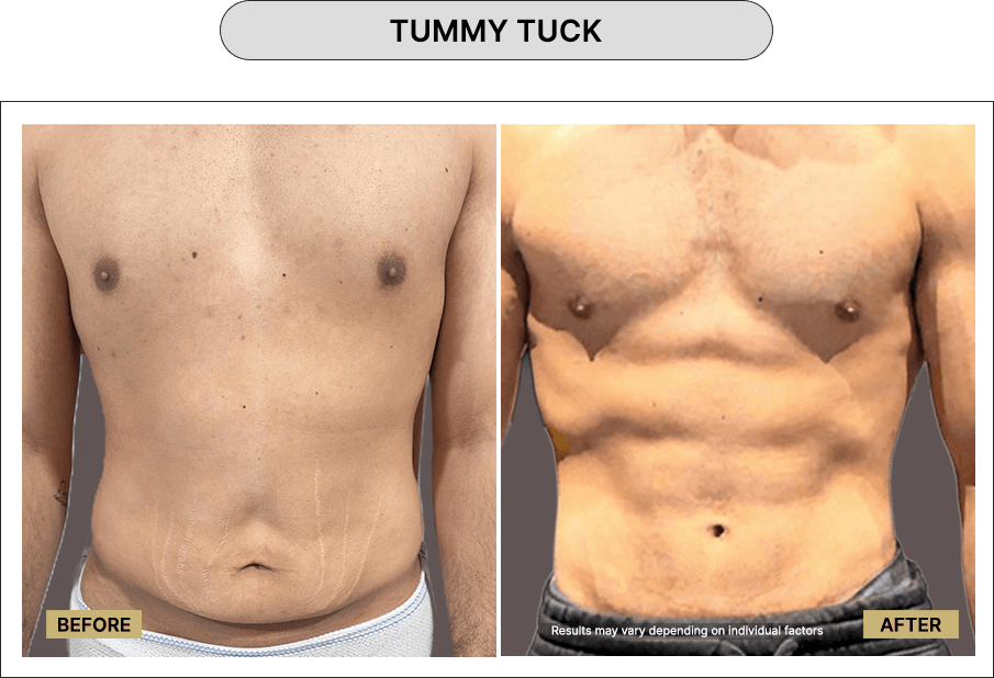 Tummy Tuck