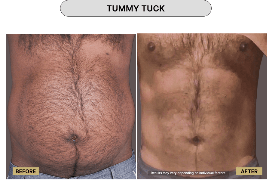 Tummy Tuck