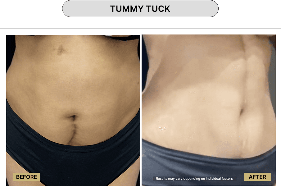 Tummy Tuck