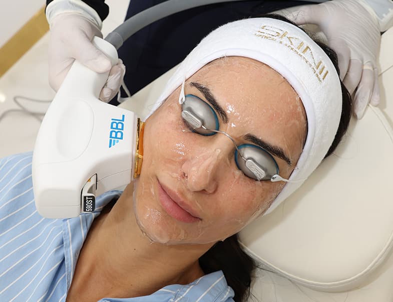 Laser hair removal