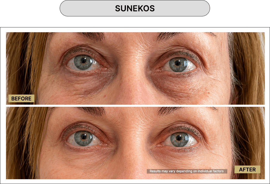 Skin111