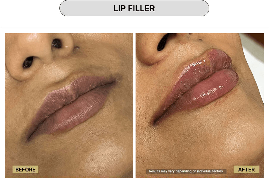 Lip Filler