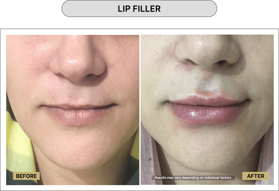 Lip Filler