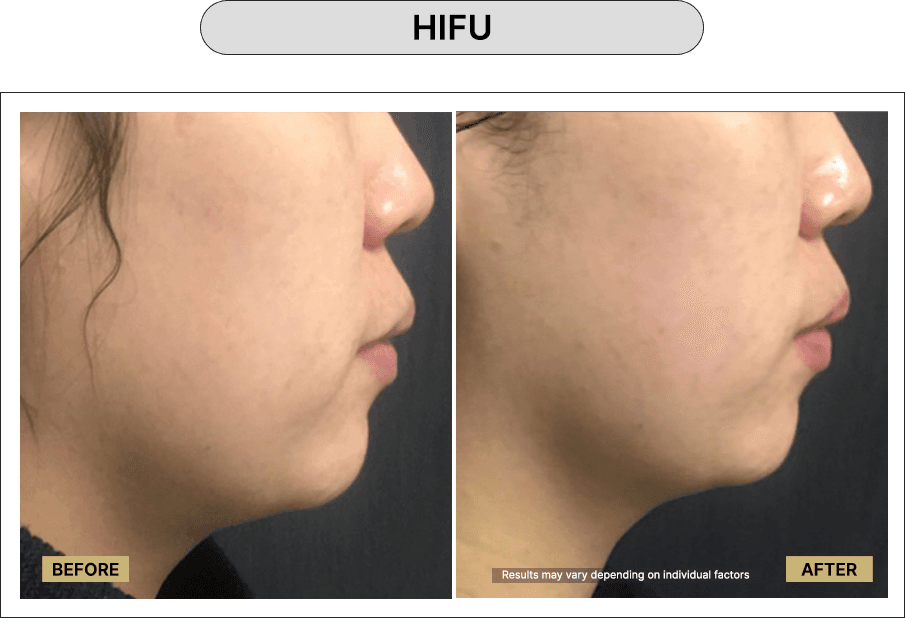 HIFU