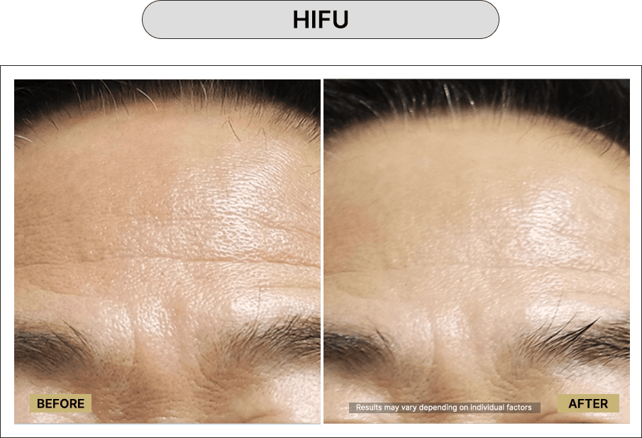 HIFU
