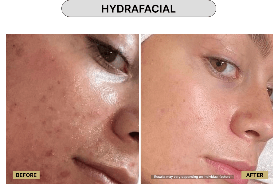 Hydrafacial