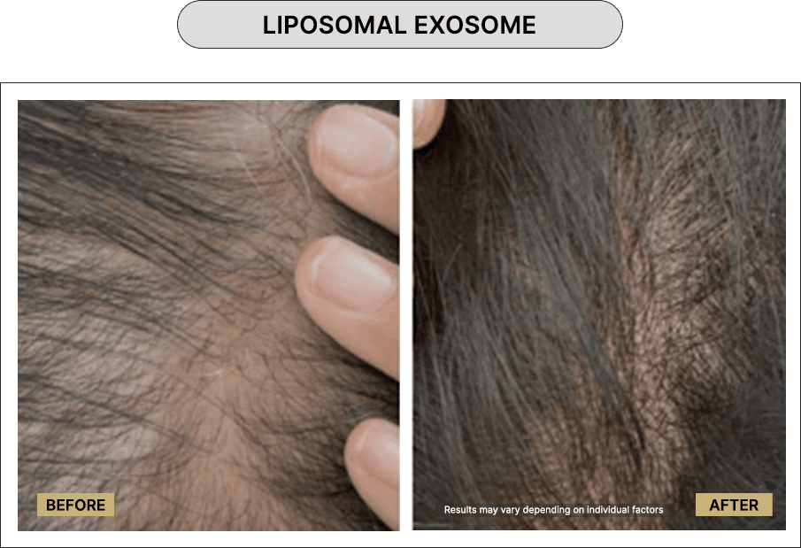 Liposomal exosome
