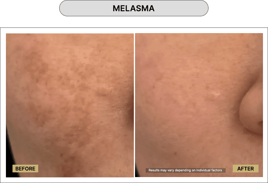 Melasma
