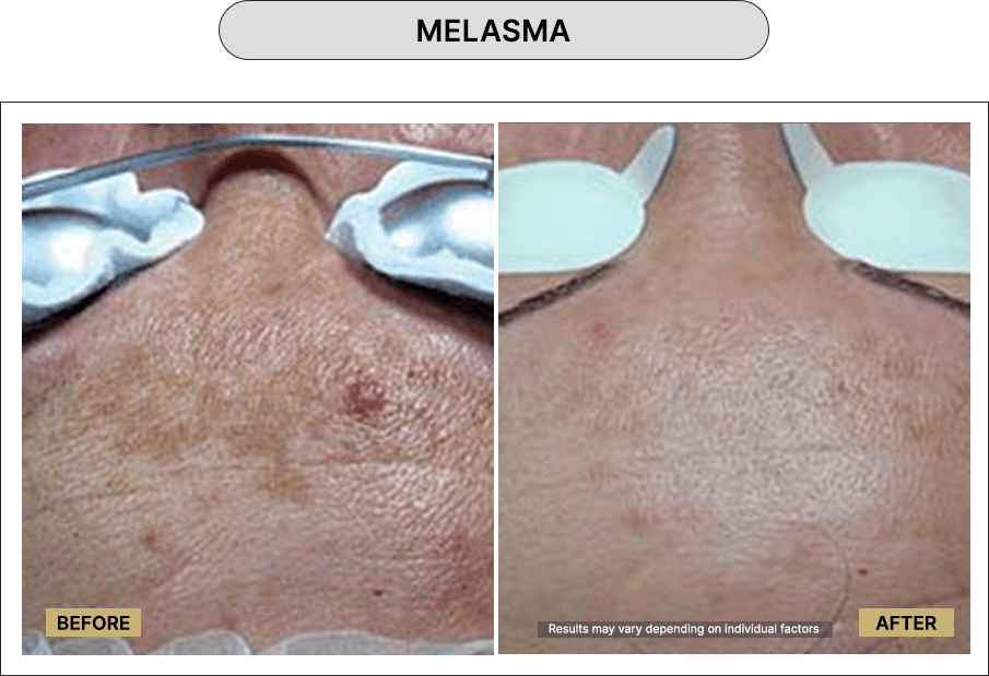 Melasma