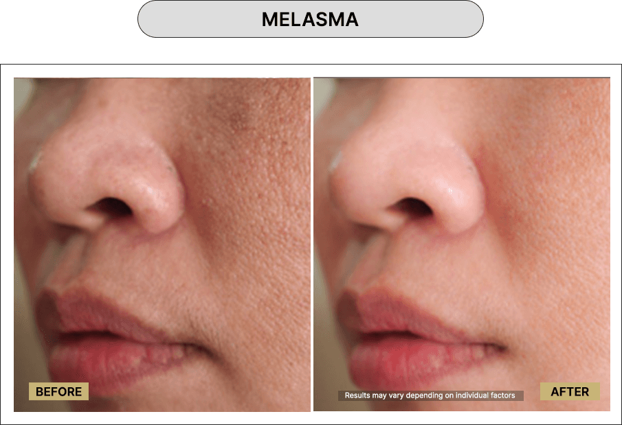 Melasma