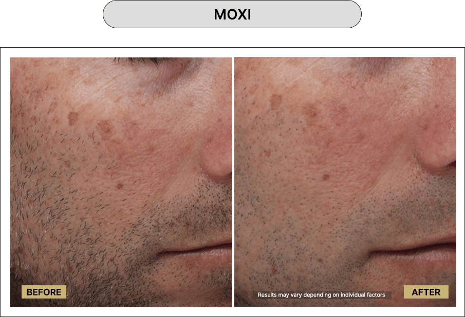 Moxi