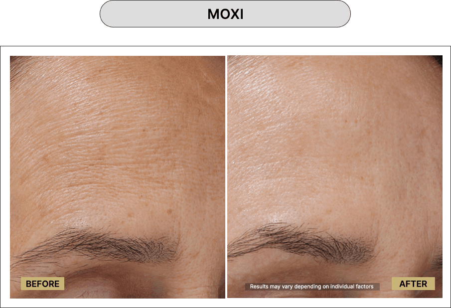 Moxi
