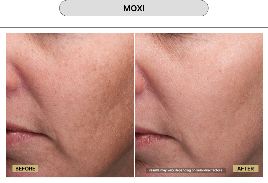Moxi