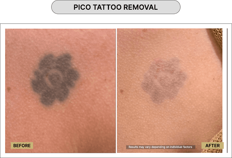 Pico Tattoo Removal