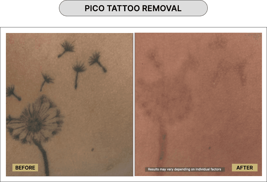 Pico Tattoo Removal