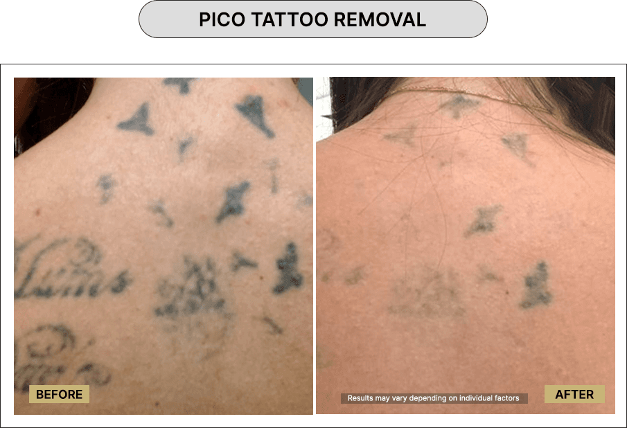 Pico Tattoo Removal