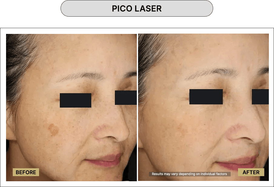 Pico Laser