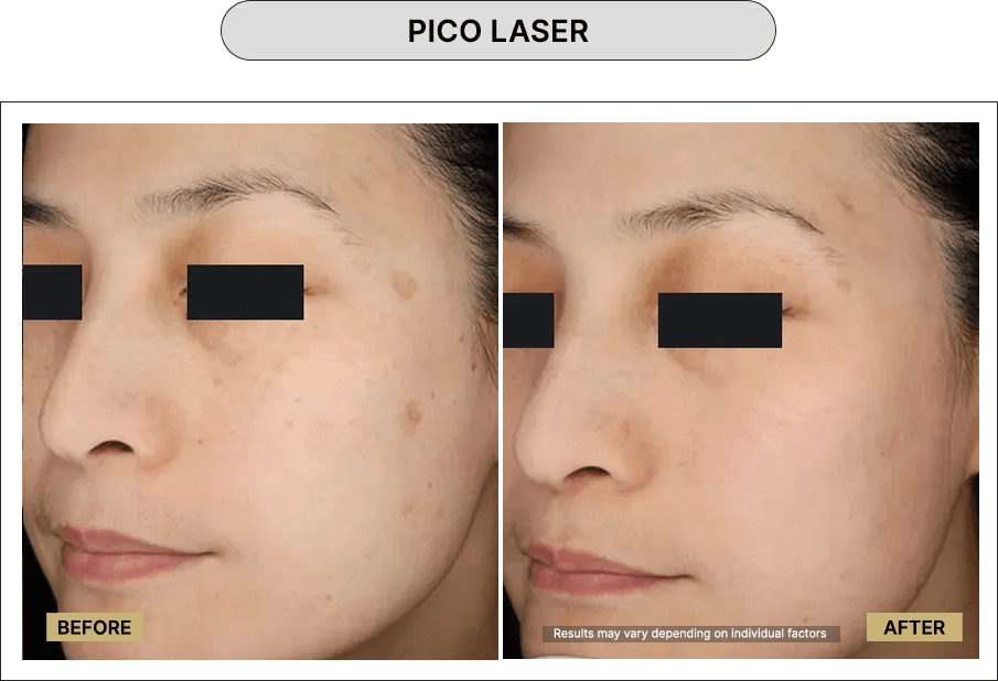 Pico Laser
