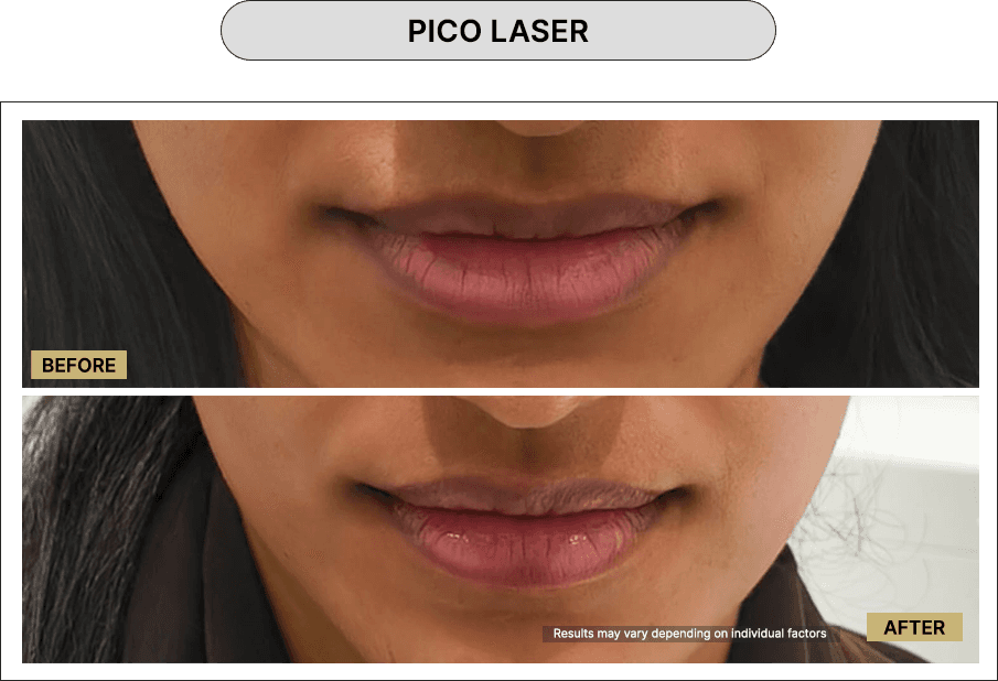 Pico Laser