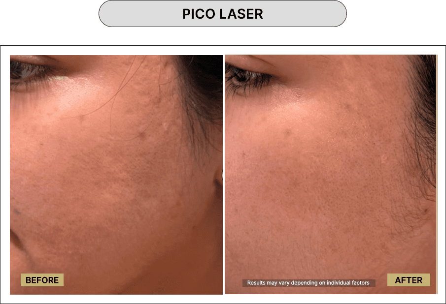 Pico Laser