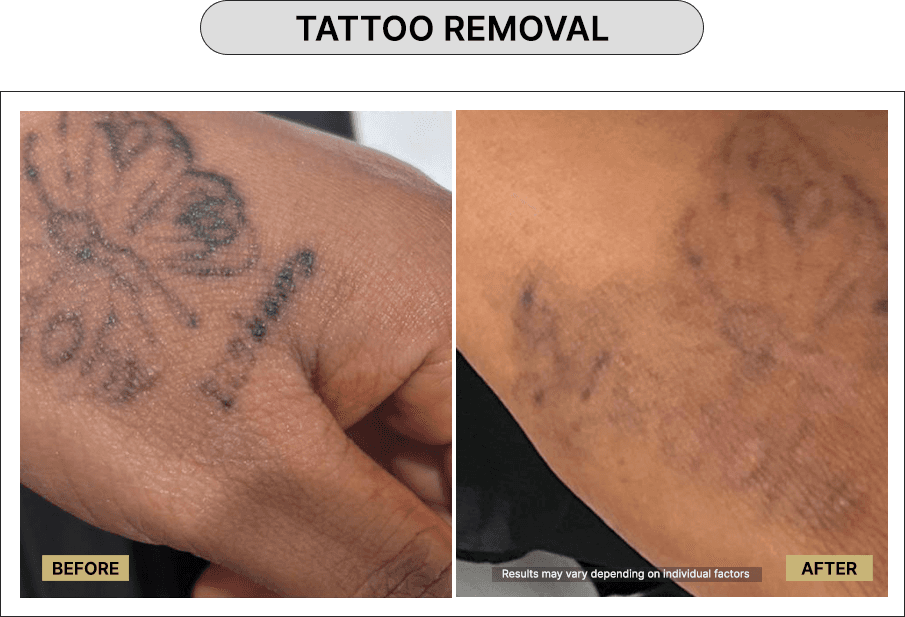 Tattoo Removal