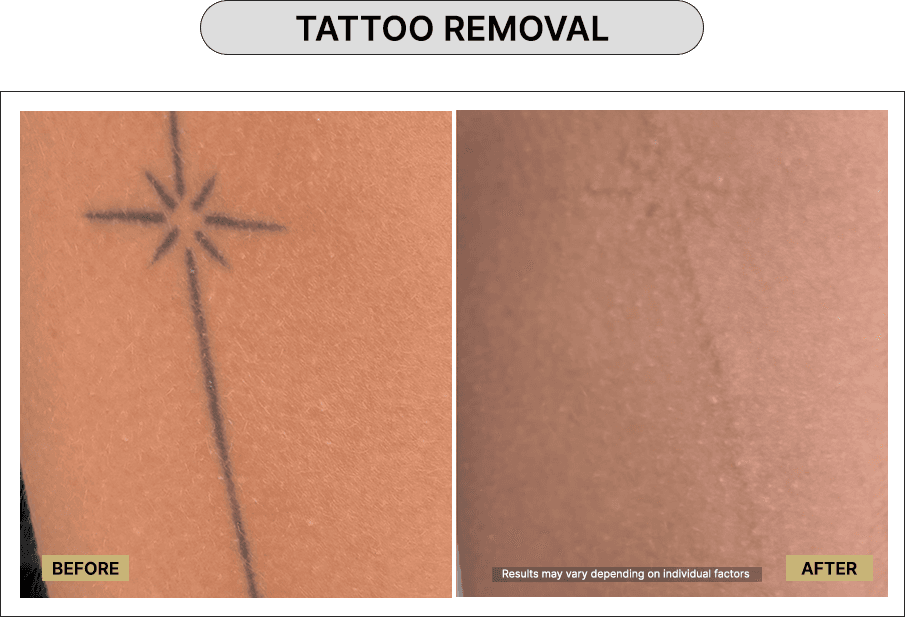 Skin111