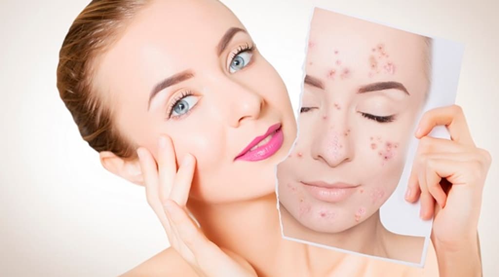 Acne Scar Survival: How to Tackle Types and Find the Right Treatment for You