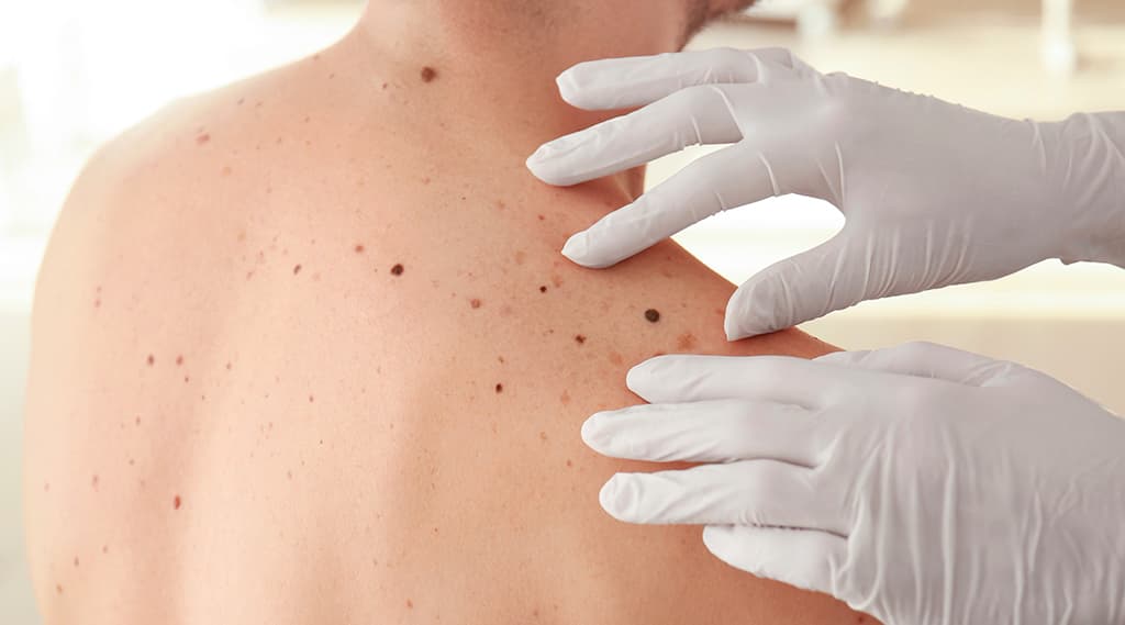 Is it Just a Mole? Understanding the Warning Signs of Melanoma